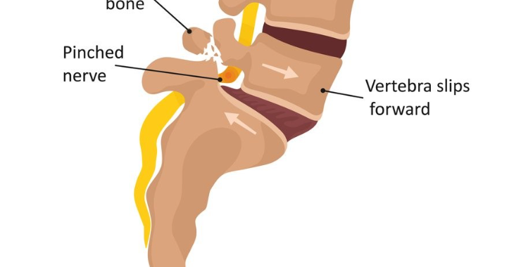 spondylolisthesis explained