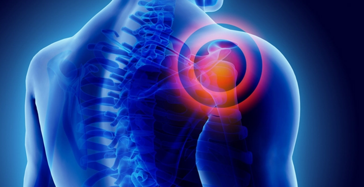 upper cross-neck, shoulder and rotator cuff pain